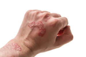 Psoriasis symptomen