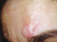 Cut-scar Scar from wound