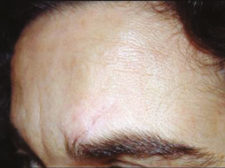 Scar-car-1 Scar from knife