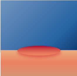 hypertrofisch litteken