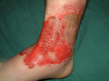 scar-car-accident Scar accident car