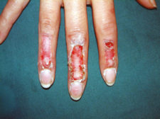 scar-hand1 scar-hand1